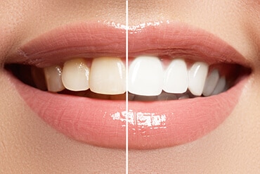 Before And After Teeth Whitening Procedure — Beautician in Coffs Harbour, NSW