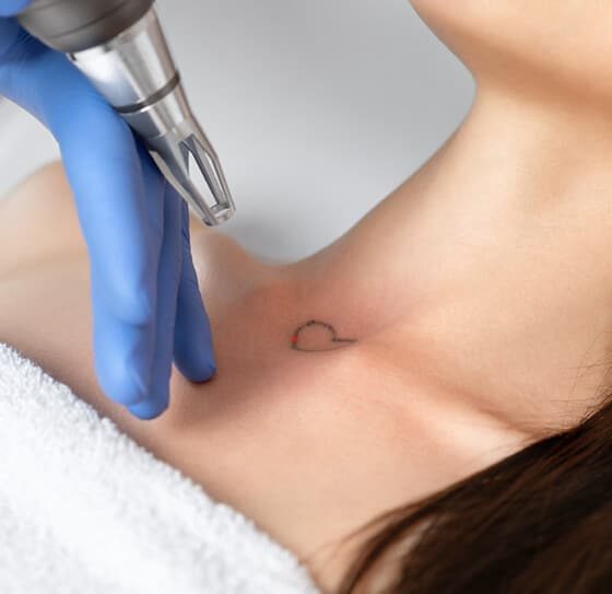 Beautician Doing Laser Tattoo Removal — Beautician in Coffs Harbour, NSW