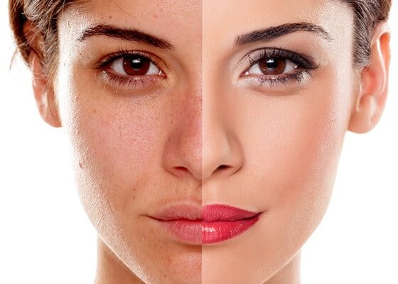 Woman Before And After Skin Treatment — Beautician in Coffs Harbour, NSW