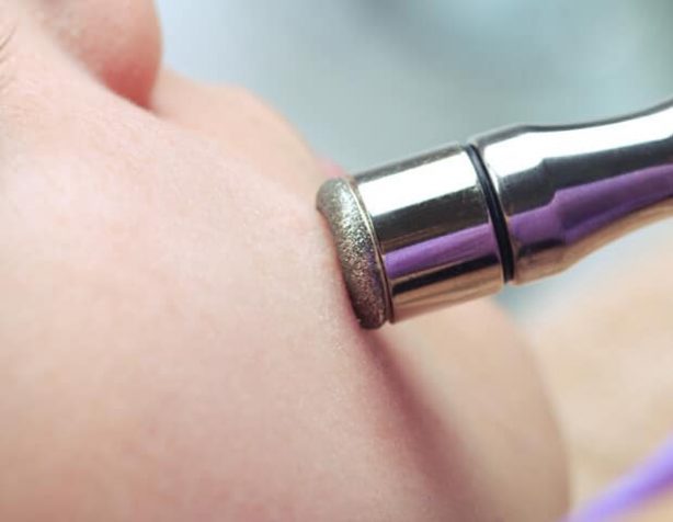 Diamond Microdermabrasion — Beautician in Coffs Harbour, NSW